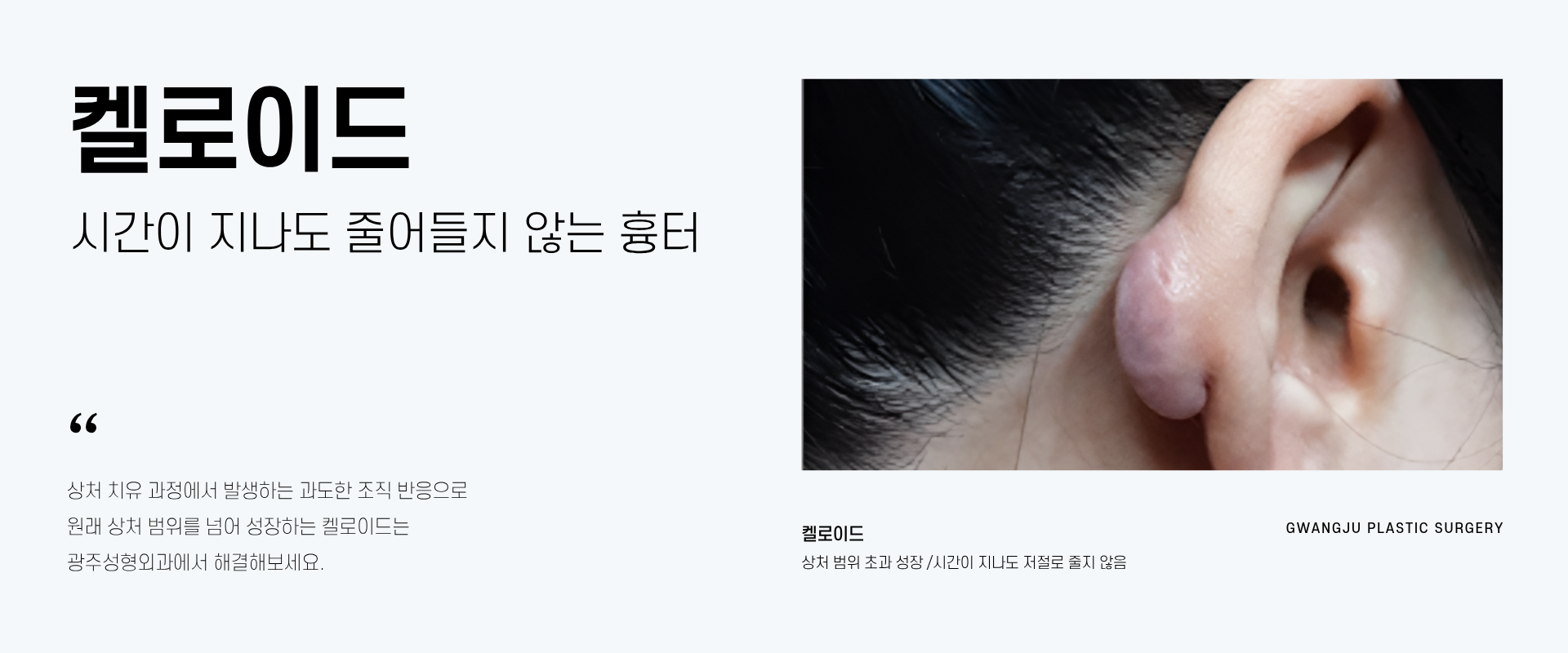 켈로이드
